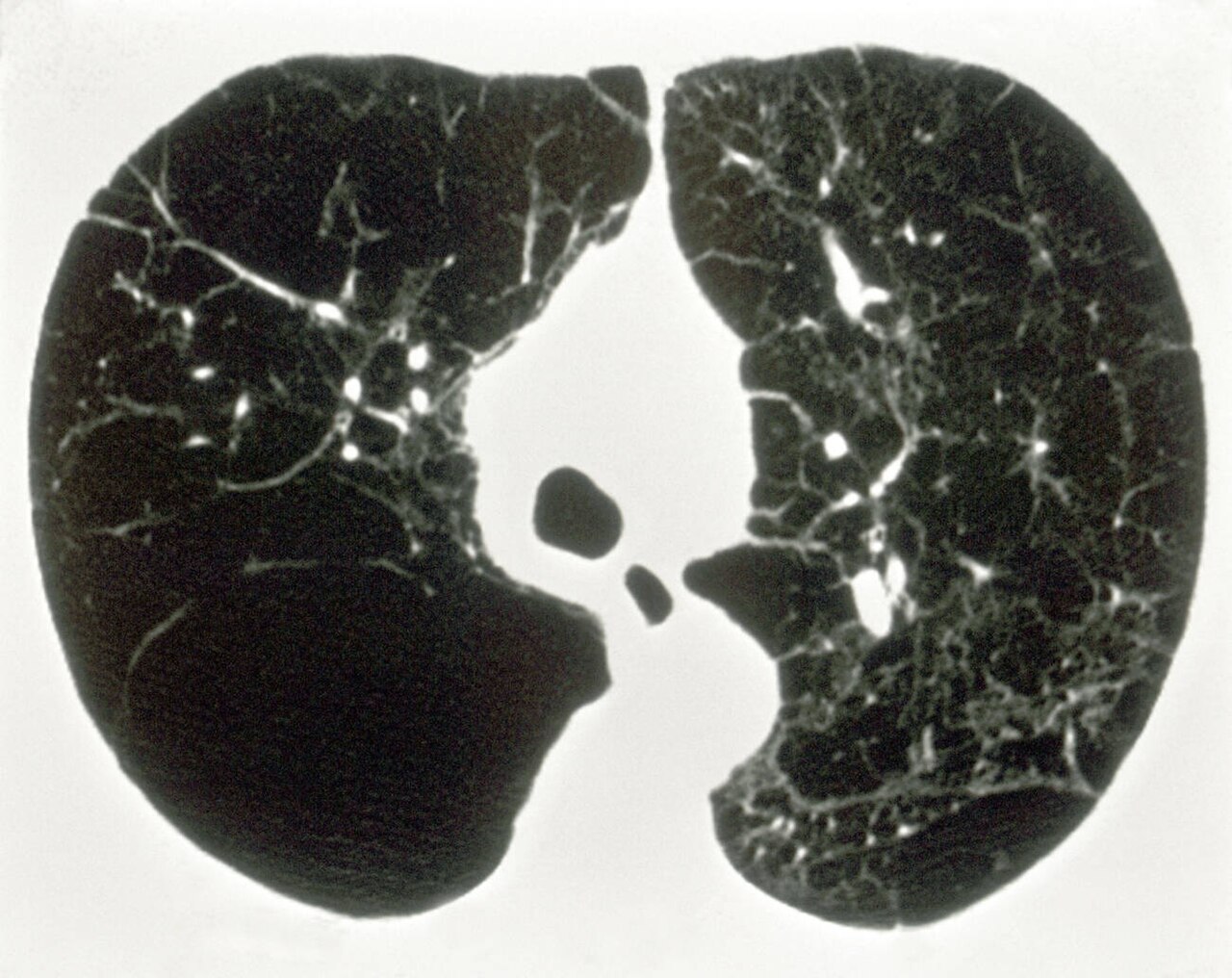 A chest CT scan